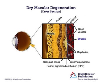 Dry Macular Degeneration