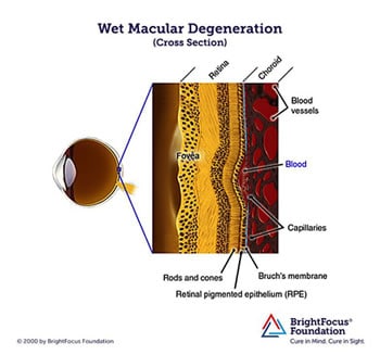 Wet Macular Degeneration